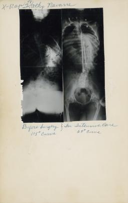 X-rays of polio survivor Kathleen Navarre before and after surgery.